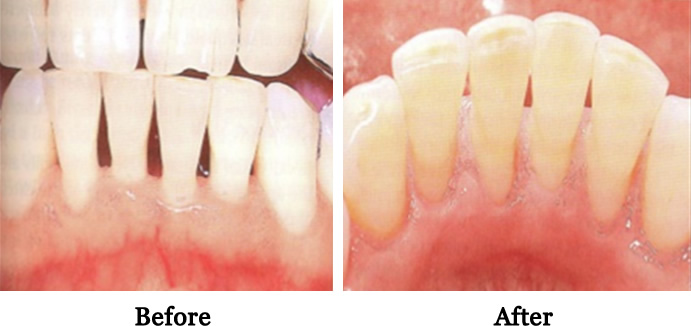 Gingival Grafts