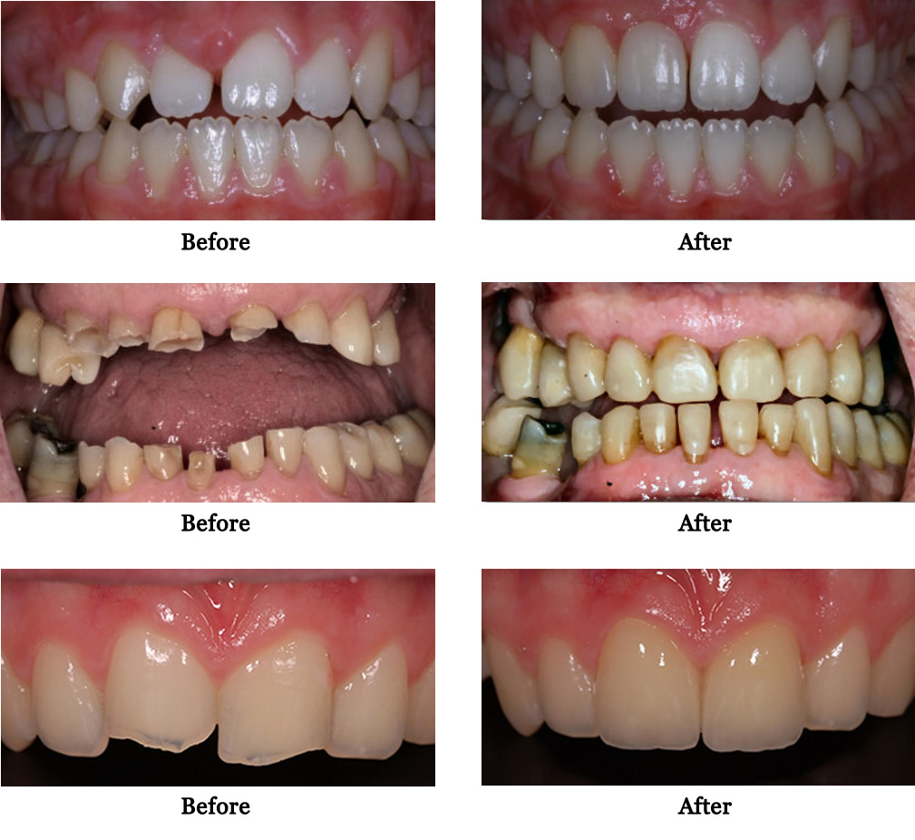 composite-restorations